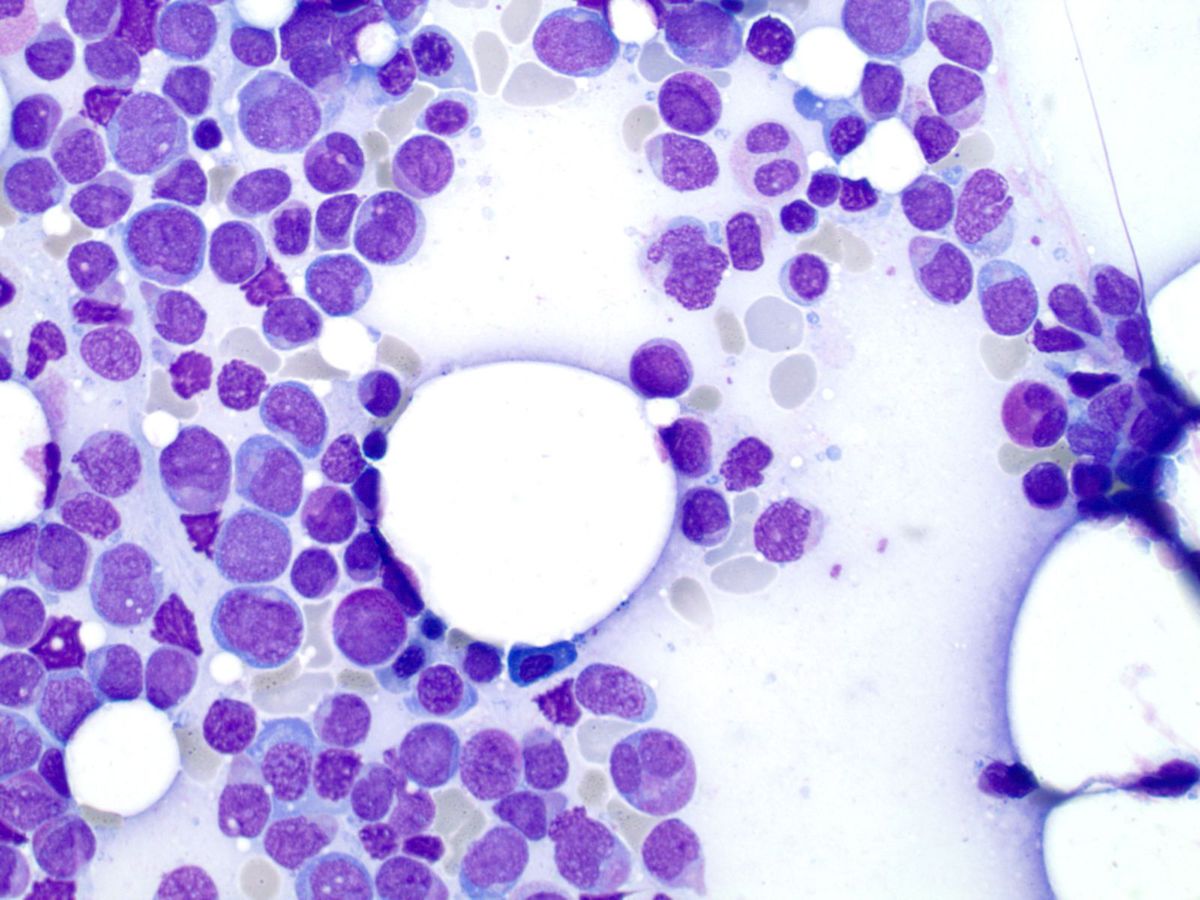 Bone marrow aspirate smear (500X) showing atypical granulocytic precursors with nuclear bi-lobation and grooves